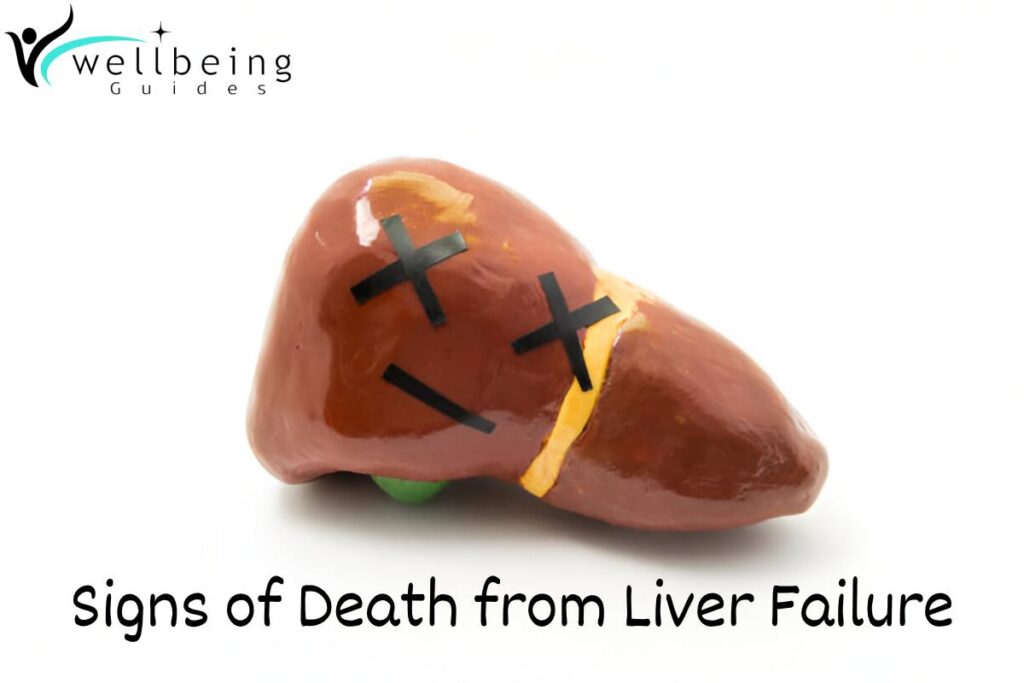 Signs of Death from Liver Failure