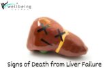 Signs of Death from Liver Failure