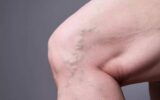 Varicose Veins and Everyday Wellness