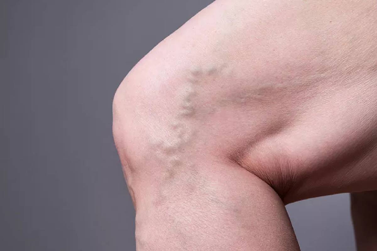 Varicose Veins and Everyday Wellness