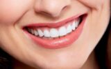 Smile Transformation