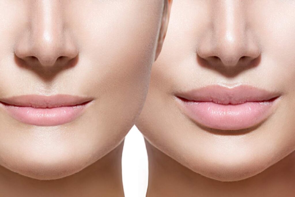 Pout Perfection: The Benefits of Lip Filler Injectables for a Stunning Smile