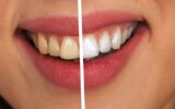 Stained Teeth Solutions: Effective Treatments for a Brighter Smile