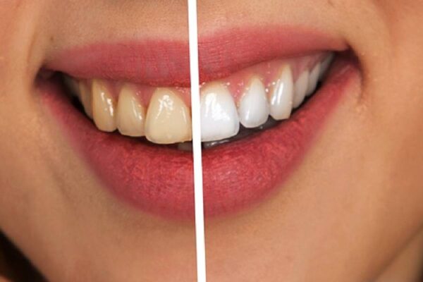 Stained Teeth Solutions: Effective Treatments for a Brighter Smile