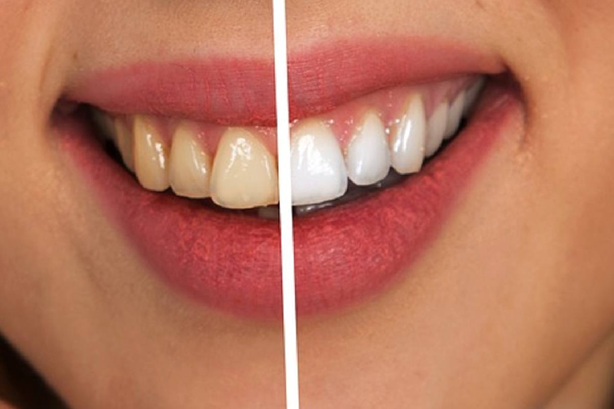 Stained Teeth Solutions: Effective Treatments for a Brighter Smile